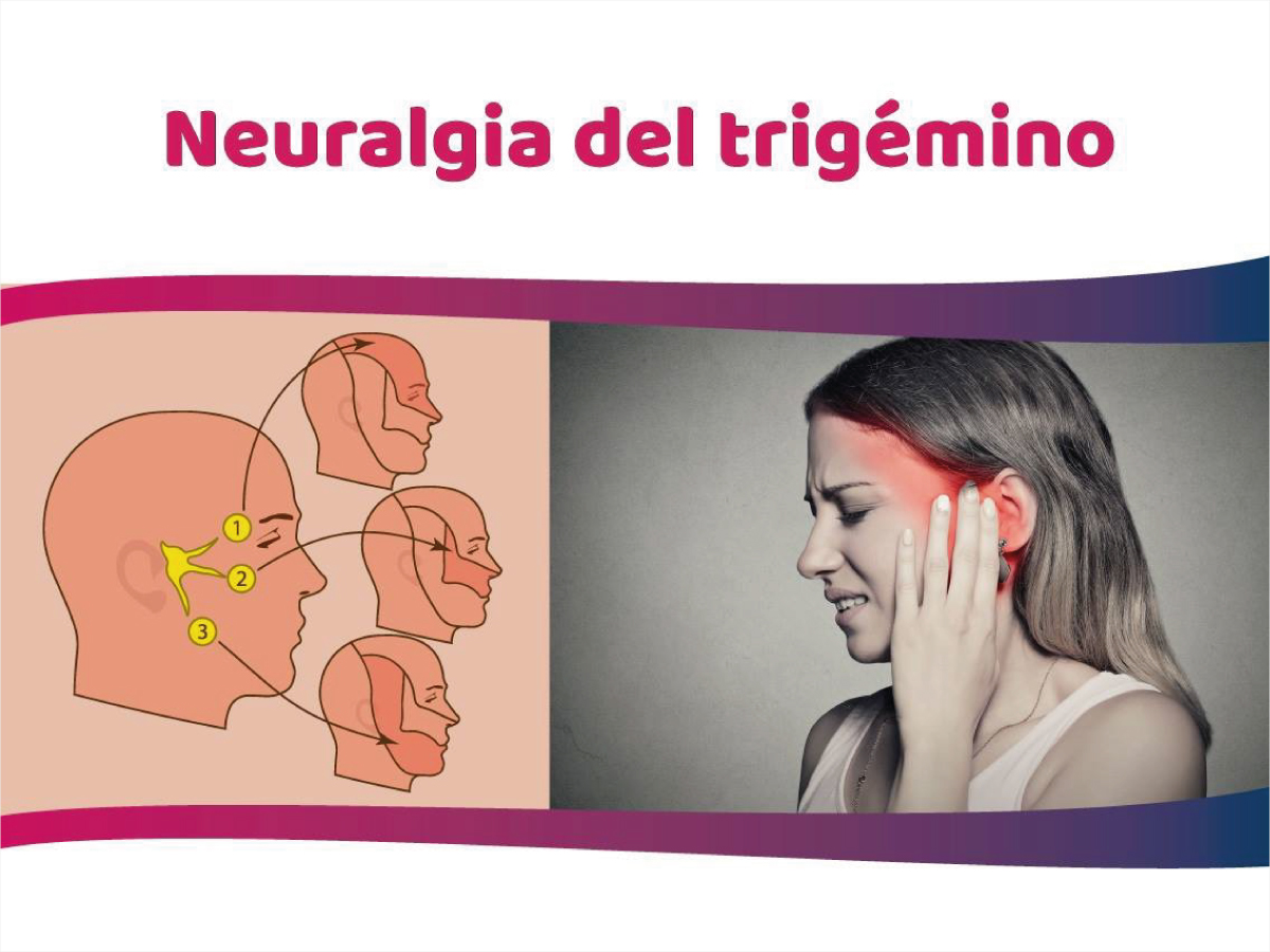 Neuralgia Del Trigémino: Efectivo Tratamiento Para El Alivio Del Dolor